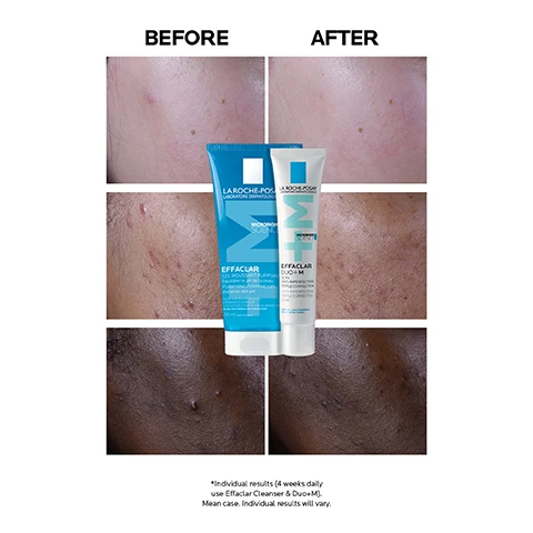 Image 1 - Before and after skin comparison showing improved complexion after using La Roche-Posay Effaclar products, with the text Before above the left side and After above the right side, featuring the product packaging in the middle and additional text stating *Individual results (4 weeks daily use Effaclar Cleanser & Duo+M). Mean case. Individual results will vary.
Image 2 - A tube of La Roche-Posay Effaclar Duo+M is displayed against a light blue background, with bold text stating UP TO 3X LESS BREAKOUTS* UNCLOGS PORES TO HELP PREVENT SPOTS. 24H HYDRATION.
Image 3 - A hand in a white glove holds a tube of La Roche-Posay Effaclar Duo + M skincare product against a light blue background, with text stating -45% POST-ACNE MARKS* and -66% BLACKHEADS*, along with additional product information and study details at the bottom.
Image 4 - A hand holds a tube of La Roche-Posay Effaclar Duo+ cream while another hand catches a small amount of the cream, with text saying apply morning and/or evening after cleansing your skin with Effaclar foaming gel.
Image 5 - A hand holds a tube of La Roche-Posay Effaclar Duo + M skincare product, featuring a light blue background with a five-star rating and testimonial text from a user about their positive experience with the product, along with the text No 1 dermatologist recommended skincare brand in the UK.
Image 6 - Image of a La Roche-Posay skincare tube labeled Effaclar Duo+M with a blue and white design, featuring text that reads number one dermatologist recommended brand in the UK and number one cream for blemish-prone skin in the UK.
Image 7 - Image shows three skincare products from La Roche-Posay labeled as Effaclar Purifying Foaming Gel, Effaclar Duo+M, and Anthelios Oil Control, with large numbers 1, 2, and 3 above them.
Image 8 - Image shows the La Roche-Posay logo at the top, followed by a health professional icon and text stating Recommended by Dermatologists, then an icon of a person touching their face with text Suitable for Sensitive Skin, followed by a droplet with a slash and text For Oily, Combination, Blemish-Prone Skin, and a comedone icon with text Non-Comedogenic.
Image 9 - A close-up of a person with short dark hair next to a white tube of La Roche-Posay Effaclar Duo+M cream, featuring text that reads La Roche-Posay, Effaclar Duo+M, Up to 3X less breakouts, 24HR hydration, unclogs pores to help prevent spots.
Image 10 - A digitally created image showing a variety of blue and turquoise organic shapes and textures, overlaid with the text PHYLOBIOMA NEW ACTIVE INGREDIENT TARGETS EXCESS SEBUM.
Image 11 - A close-up image of a persons face on the left and a blue-toned digital representation on the right, with visible text that reads Discover SpotScan+ for breakout-prone skin analysis developed by dermatologists & powered by AI.