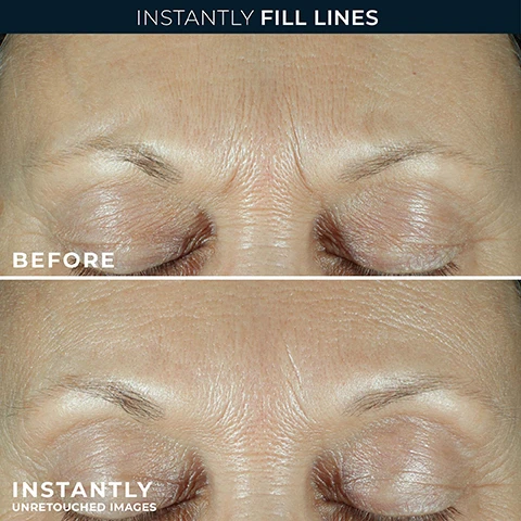 Image 1 - A before and after comparison image shows a persons forehead and eye area, with the top section displaying noticeable wrinkles and the bottom section showing the skin with greatly reduced wrinkles, with visible text INSTANTLY FILL LINES BEFORE INSTANTLY UNRETOUCHED IMAGES. Image 2 - A smiling board-certified dermatologist, Dr. Nozile, is shown in a black and white headshot against a backdrop of textured skin with an amber liquid drop; the text reads: BOARD-CERTIFIED DERMATOLOGIST DR. NOZILE AS A DERMATOLOGIST, IM ALWAYS EXCITED TO FIND PRODUCTS THAT DELIVER REAL RESULTS, AND ROCS FILL + TREAT SERUM DOES JUST THAT. Image 3 - An image divided into three sections: the top shows a golden liquid with bubbles and text Patented Retinol Visibly Reduces Lines; the middle displays a light blue liquid with large bubbles and text Triple Hyaluronic Acid Boosts Hydration and Plumps; the bottom features a green honeycomb-like pattern with text Swertiamarin Visibly Restores and Smooths Skin. Image 4 - A light grey ROC serum bottle with gold accents stands next to large black text stating 97% HAD VISIBLY FILLED LINES and 100% HAD DEEP WRINKLES VISIBLY REDUCED IN 4 WEEKS, while the bottle itself displays ROC CLINICALLY PROVEN DERM CORREXION® SERUM COMBLER + TRAITER + RÉTINOL AVANCÉ FILL + TREAT SERUM + ADVANCED RETINOL 15 mL e, and CLINICALLY PROVEN is also written at the bottom.