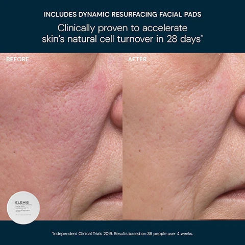 Image 4 - A split image shows a close-up of a persons skin, with the left side labeled BEFORE displaying skin with more visible pores and some redness, and the right side labeled AFTER displaying smoother skin with reduced pore visibility and redness, with a white Elemis product jar in the bottom left corner. The visible text is: INCLUDES DYNAMIC RESURFACING FACIAL PADS Clinically proven to accelerate skins natural cell turnover in 28 days* BEFORE AFTER ELEMIS DYNAMIC RESURFACING FACIAL PADS Skin refining pads Disques affinant le grain de peau 14 x 2.1 in (5.5 cm) DIA Pads *Independent Clinical Trials 2019. Results based on 36 people over 4 weeks. Image 5 - The image shows a white round jar of Elemis Dynamic Resurfacing Facial Pads and a tall white pump bottle of Elemis Dynamic Resurfacing Super-C Serum on a blue background, accompanied by text reading DYNAMIC RESURFACING FACIAL PADS Clinically proven to accelerate skin’s natural cell turnover in 28 days* and DYNAMIC RESURFACING SUPER-C SERUM Clinically proven to reduce pigmentation and dark spots**, with additional product information on the jar stating Skin refining pads Disques affinant le grain de peau 14 x 2.1 in (5.5 cm) DIA Pads, and on the bottle stating Brightening antioxidant serum Sérum antioxydant illuminateur, followed by footnotes at the bottom *Independent Clinical Trials 2019. Results based on 36 people over 4 weeks. **Independent clinical trial 2021. Results based on 90 people over 28 days. Image 6 - An Elemis Dynamic Resurfacing skincare routine is depicted in three steps against a dark blue background, starting with Step 1: Cleanser, a white pump bottle labeled Elemis Dynamic Resurfacing Facial Wash Skin refining cleanser Nettoyant lissant pour la peau, identified for Renew & Purify; followed by Step 2: Exfoliator, a white circular tub labeled Elemis Dynamic Resurfacing Facial Pads Skin refining pads Disques affinant le grain de peau 14 x 2.1 in (5.5 cm) DIA Pads, identified for Resurface & Smooth; and concluding with Step 3: Serum, a white pump dispenser bottle labeled Elemis Dynamic Resurfacing Super-C Serum Brightening antioxidant serum Sérum antioxydant illuminateur, identified for Refine & Brighten.